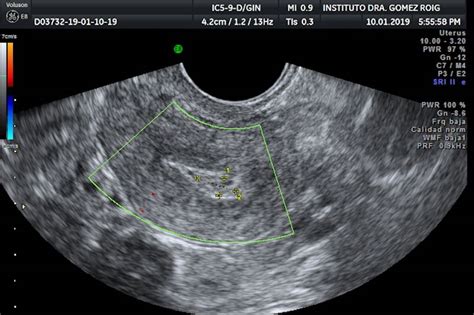 imagen de una ecografía transvaginal mostrando ovarios con múltiples folículos