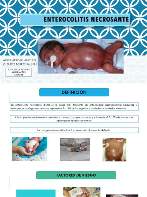 Bebé con distensión abdominal, uno de los síntomas de enterocolitis necrosante