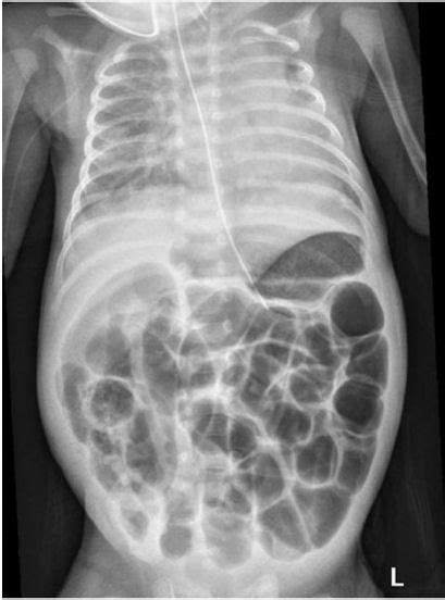 Imagen de una radiografía abdominal mostrando neumatosis intestinal y gas venoso portal en un neonato con ECN