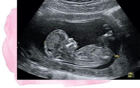Ecografía de un feto a las 39 semanas de gestación