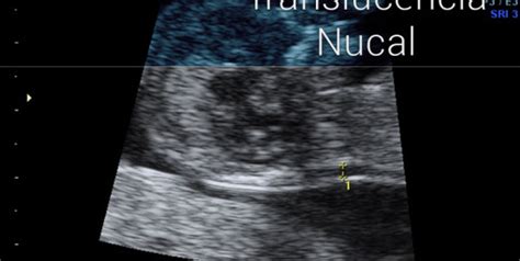 ultrasonido mostrando la medición de la translucencia nucal en el cuello del feto