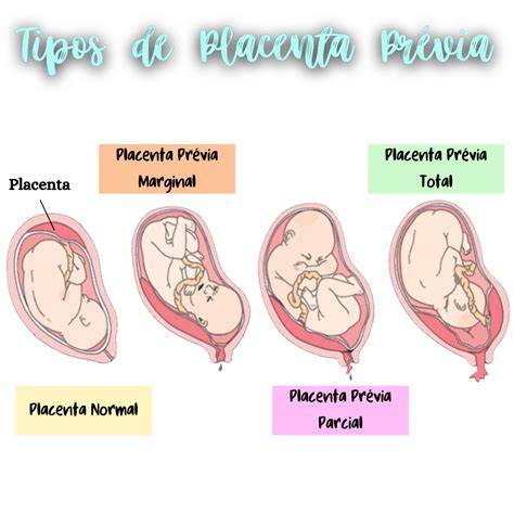 Gráfico comparativo de los tipos de placenta previa