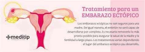 Diagrama que compara los métodos de tratamiento para el embarazo ectópico: farmacológico y quirúrgico.