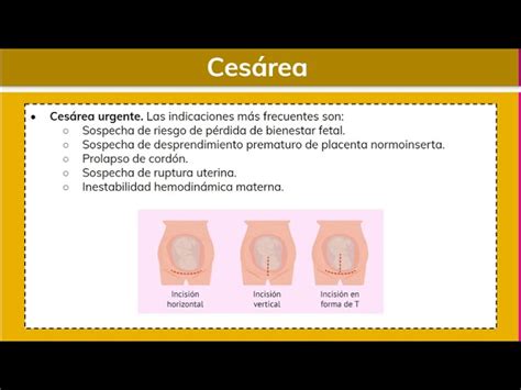 Ilustración de tipos de incisiones de cesárea (vertical y horizontal) en el abdomen