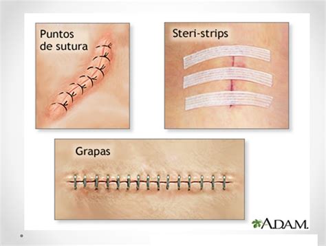 Diagrama mostrando métodos de cierre de heridas quirúrgicas (grapas, suturas, adhesivo quirúrgico, Steri-Strips)