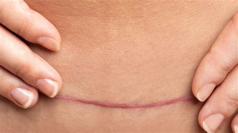 Mujer duchándose y secando suavemente su cicatriz de cesárea