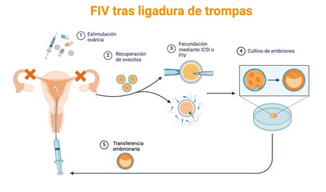 Diagrama comparativo de las diferentes técnicas de ligadura de trompas: salpingectomía parcial, oclusión con clips, electrocoagulación.