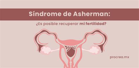 Esquema del síndrome de Asherman y los enfoques de tratamiento regenerativo