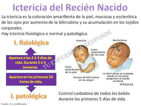 Esquema de la progresión cefalocaudal de la ictericia en el recién nacido, ilustrando cómo la coloración avanza desde la cabeza hacia las extremidades.