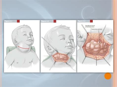 Esquema anatómico mostrando la localización del higroma quístico en la región cervical fetal y su relación con el sistema linfático.