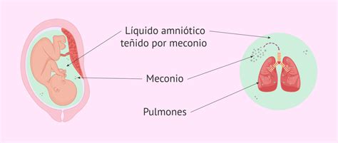 Esquema anatómico mostrando el paso del meconio al líquido amniótico y su posterior inhalación hacia los pulmones del recién nacido.