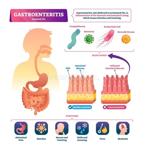 Esquema fisiopatológico de la gastroenteritis aguda: mecanismos de secreción y absorción intestinal.