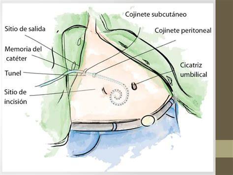Esquema de la colocación de un tocotransductor en el abdomen materno