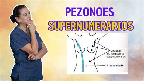 Esquema de las líneas mamarias donde se localizan habitualmente los pezones supernumerarios