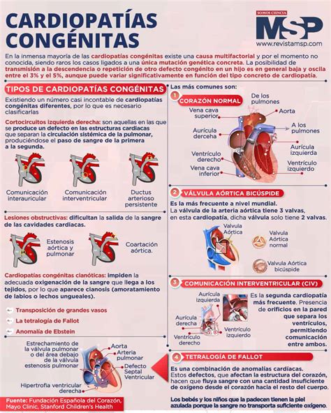 Infografía comparativa de las cardiopatías congénitas más comunes