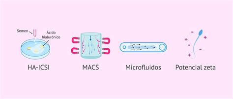 Infografía comparativa de las técnicas de selección espermática: MACS frente a chips de microfluidos.