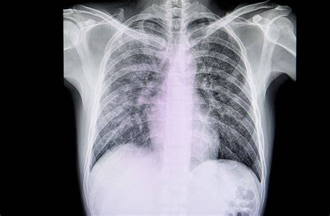 Radiografía de tórax de un cachorro mostrando opacidades pulmonares compatibles con neumonía.