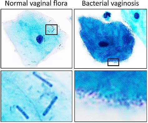 Infografía detallando la composición de la flora vaginal normal y alterada en casos de vaginosis bacteriana.
