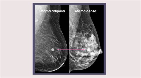 Ilustración médica que muestra la estructura del tejido mamario con áreas de fibrosis y quistes, destacando la textura grumosa.