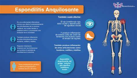 Esquema de las articulaciones afectadas por la espondilitis anquilosante