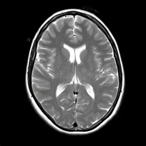 Imagen de resonancia magnética cerebral de un bebé, destacando diferentes áreas de desarrollo.