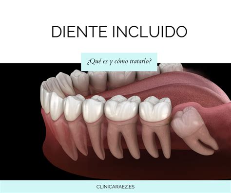 Esquema que ilustra las diferentes posiciones anómalas de un diente incluido.