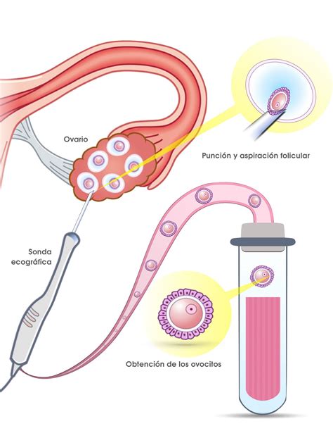 Representación esquemática del procedimiento de punción folicular para la extracción de óvulos.