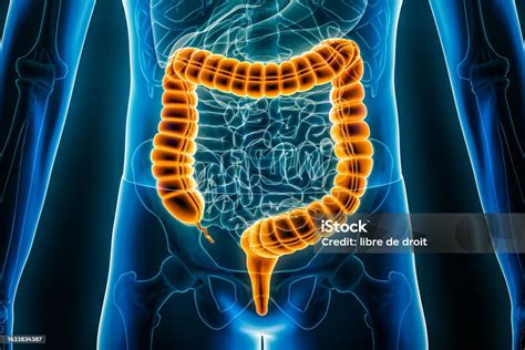 diagrama del colon humano mostrando la ubicación de los divertículos