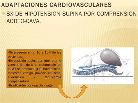 Diagrama que ilustra la compresión aorto-cava y sus efectos hemodinámicos.
