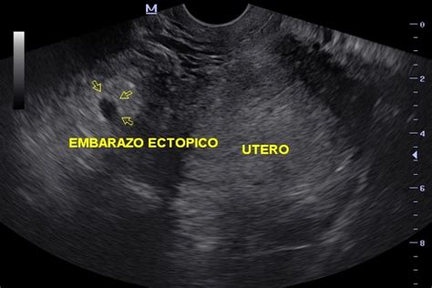 Imagen de ecografía transvaginal que muestra un embarazo ectópico en la trompa de Falopio.