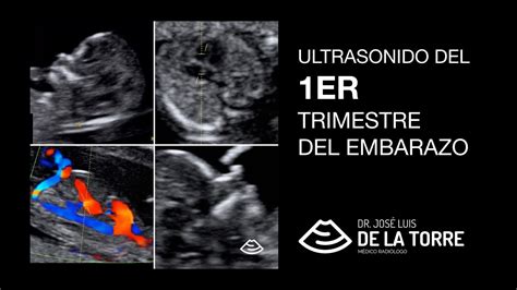 Esquema explicativo del tamizaje combinado del primer trimestre que integra la fracción libre de beta HCG, PAPP-A y ecografía genética.