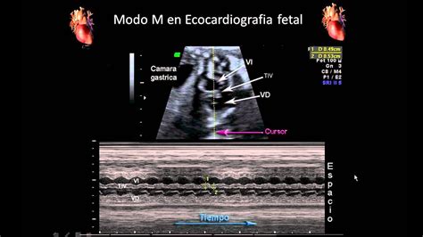 Ultrasonido mostrando el corazón fetal latiendo
