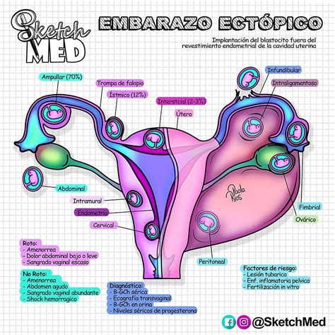 Diagrama de las diferentes localizaciones de un embarazo ectópico