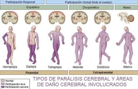 Diagrama ilustrando los diferentes tipos de parálisis cerebral (espástica, atetoide, atáxica, mixta) con sus características principales.