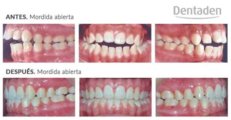 Infografía comparativa: alineación dental correcta frente a los efectos de una mordida abierta y protrusión dental.