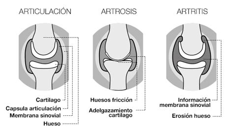 Esquema anatómico mostrando la diferencia entre una articulación sana con cartílago intacto y una articulación con artrosis, destacando el desgaste y los osteofitos.