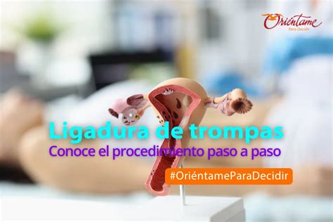 Esquema médico sencillo que ilustra la diferencia entre el procedimiento de vasectomía y ligadura de trompas.