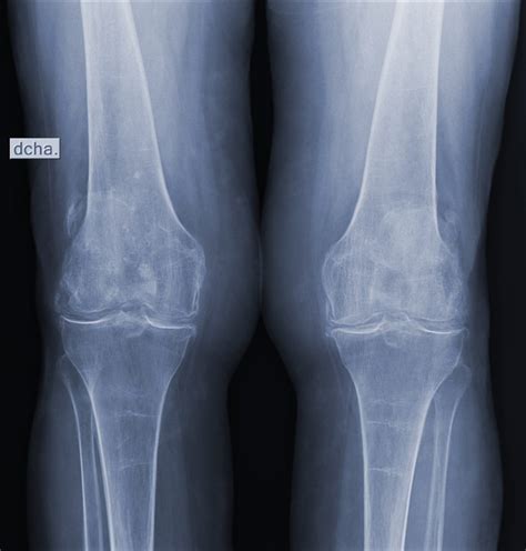 Imagen de una radiografía de rodilla mostrando signos de inflamación y posible infección articular.
