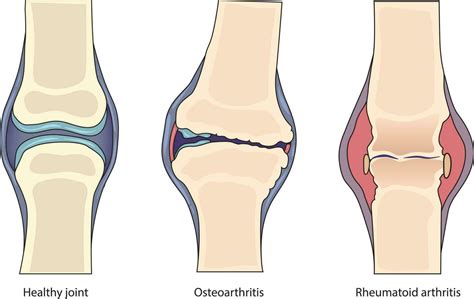 Diagrama comparativo de una articulación sana y una afectada por artritis séptica avanzada.