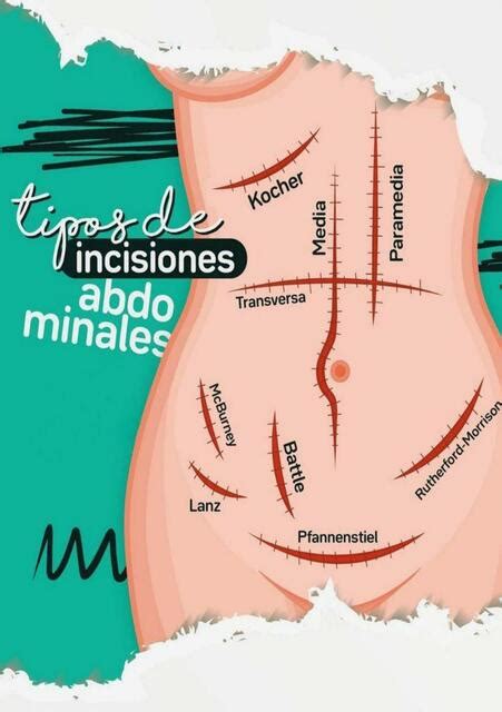 Infografía sobre los tipos de incisiones abdominales: horizontal (bikini), vertical y en forma de T.