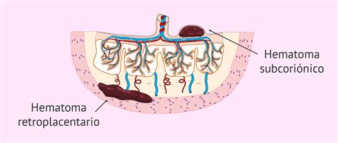 Esquema explicativo de la localización de los hematomas intrauterinos (subcoriónicos, retroplacentarios) y su relación con la placenta y el feto.