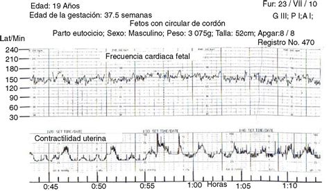 Gráfico de cardiotocografía 3G mostrando datos de latido fetal y contracciones