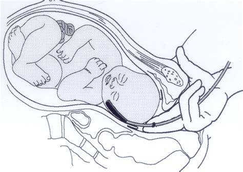 Ilustración del sensor de pulsioximetría fetal colocado en la mejilla del bebé