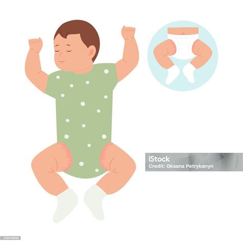 Ilustración de un bebé con erupción cutánea en la zona del pañal