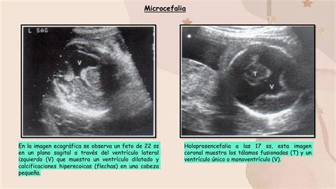 Imagen de ecografía que muestra microcefalia fetal