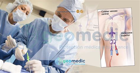 Esquema del procedimiento de colocación del catéter y cánula interna en inseminación post-cervical en cerdas