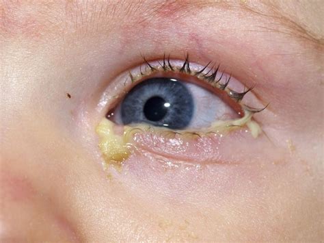 Foto de ojo de bebé con conjuntivitis neonatal