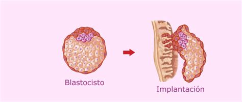 Representación esquemática de la implantación del blastocisto en el endometrio uterino.