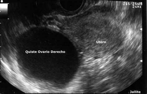 Esquema de ubicación de un quiste ovárico fetal en el abdomen
