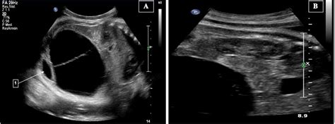 Ecografía de quiste ovárico fetal